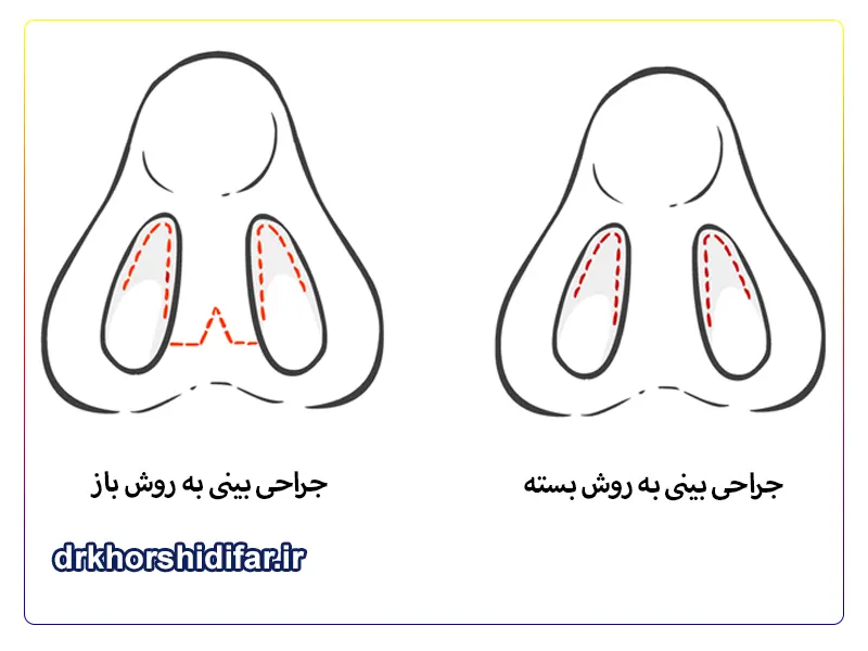 جراحی بینی به روش باز و بسته