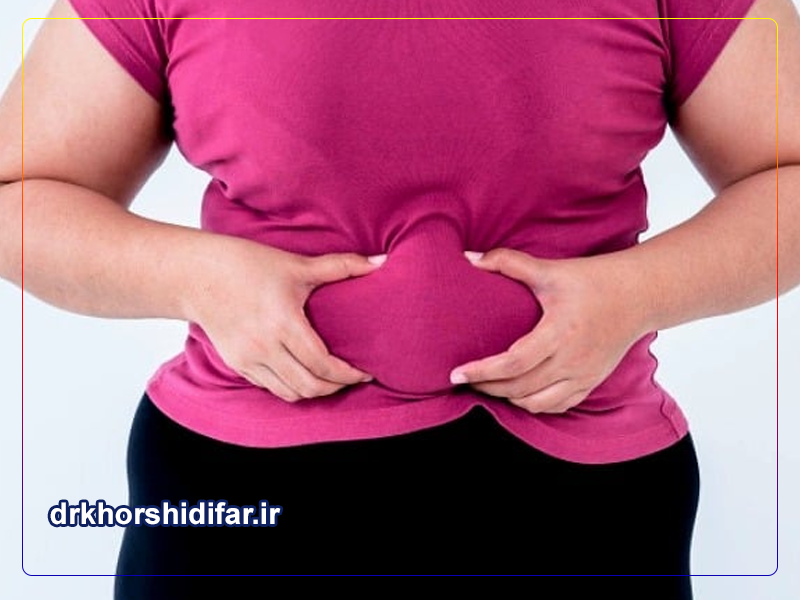 جراحی مینی ابدومینوپلاستی