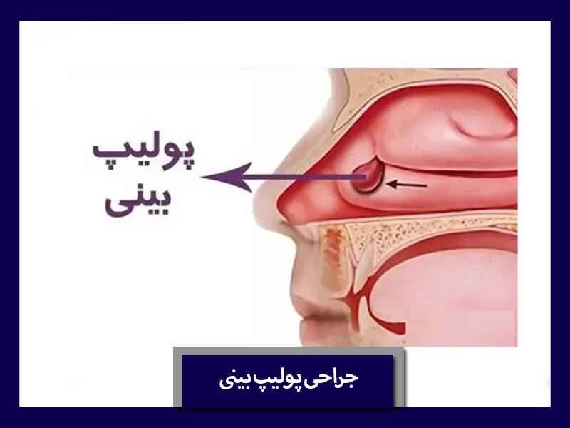 جراحی پولیپ بینی 
