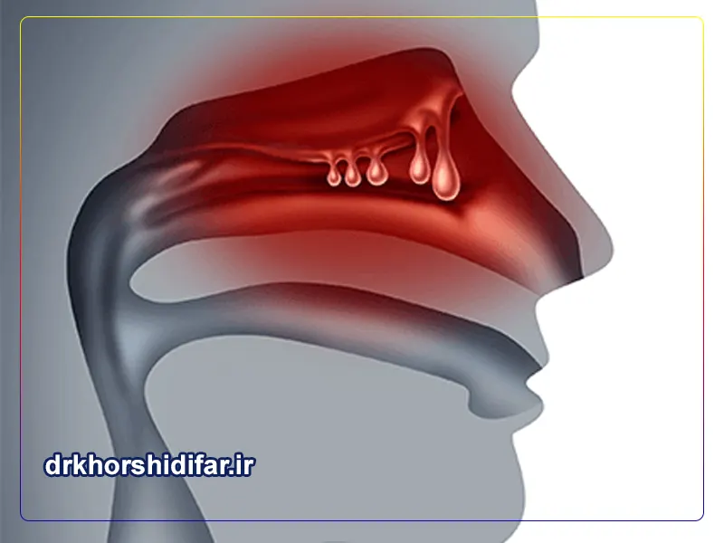 عمل پولیپ بینی