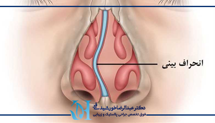 جراحی انحراف بینی