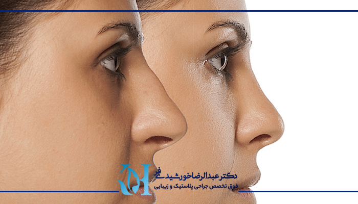 جراحی بینی استخوانی 